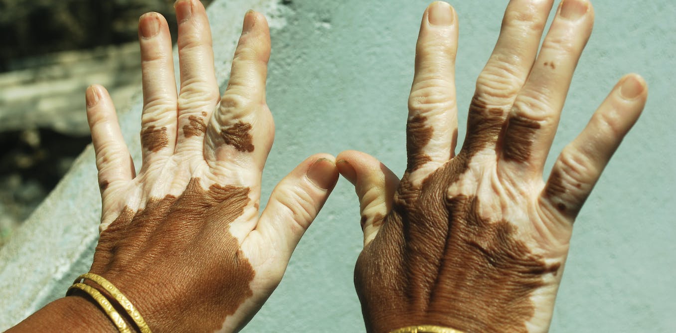 Hands of a person with Vitiligo